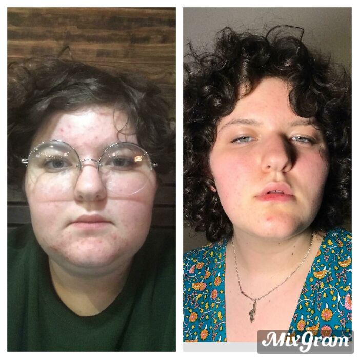 A woman's before and after comparison of her face, showing changes. People left speechless at reunions.