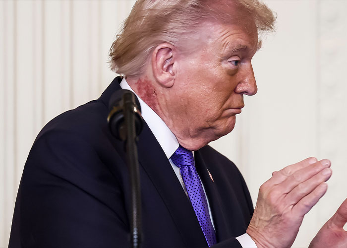 Following Trump&rsquo;s Abrupt Interview Exit, Health‑Related Observations Surface Among Viewers