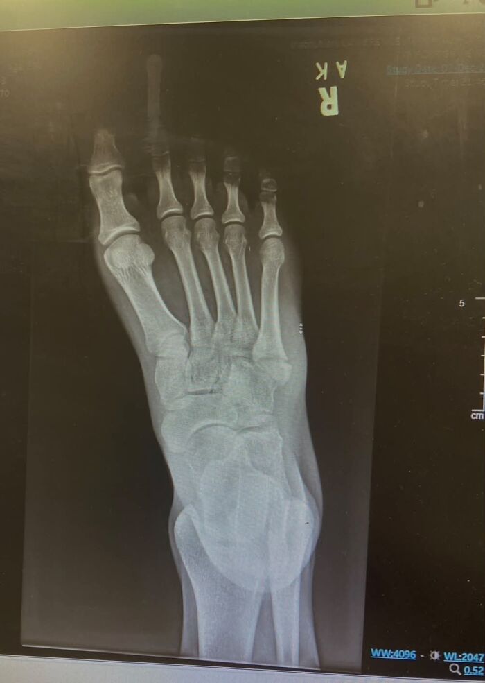 An X-ray of a human foot, showing bones, potentially an unserious ER visit for a minor issue.