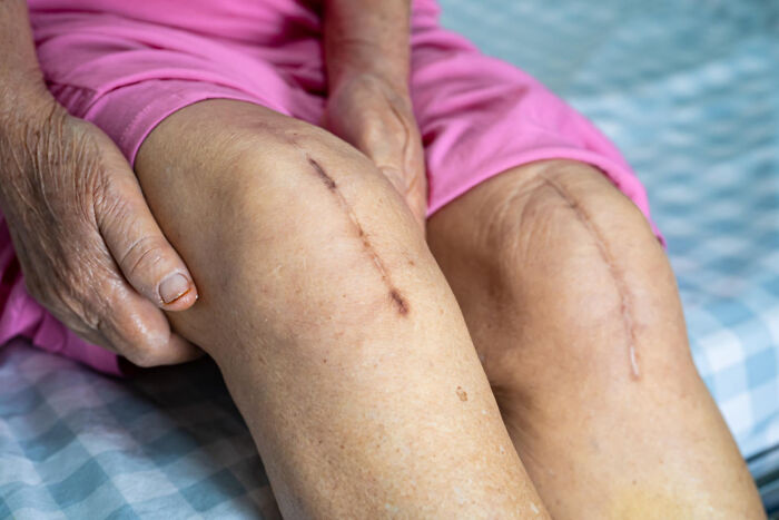 Close up of elderly knees with scars highlighting human body healing