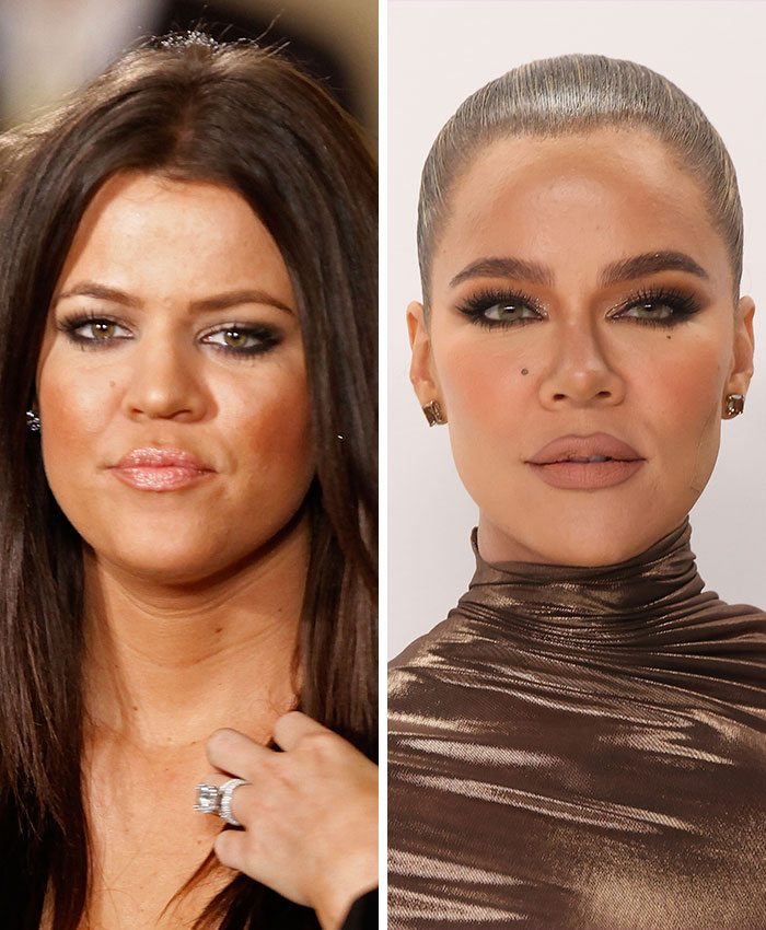 Side-by-side before and after images showing plastic surgery effects