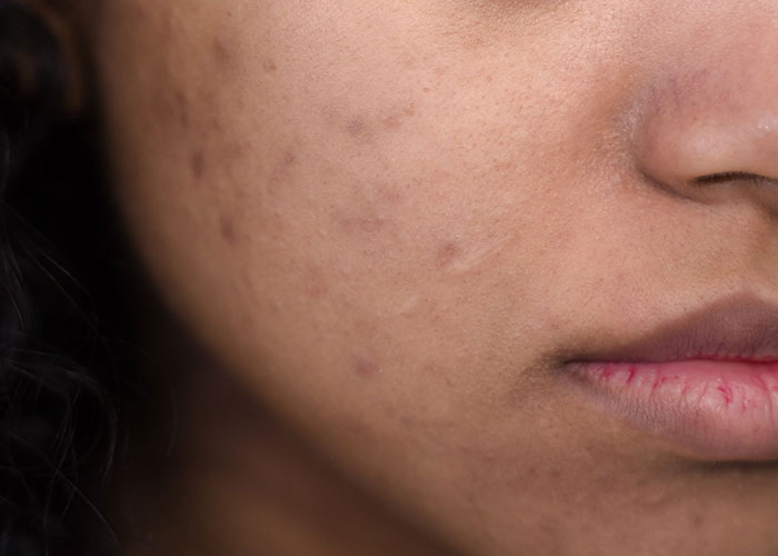 Close-up of a person's face with skin imperfections, representing a difficult period when kids can’t keep contact with parents.