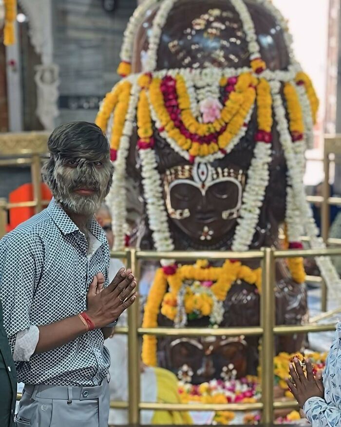 Person with hypertrichosis standing near floral-decorated statue