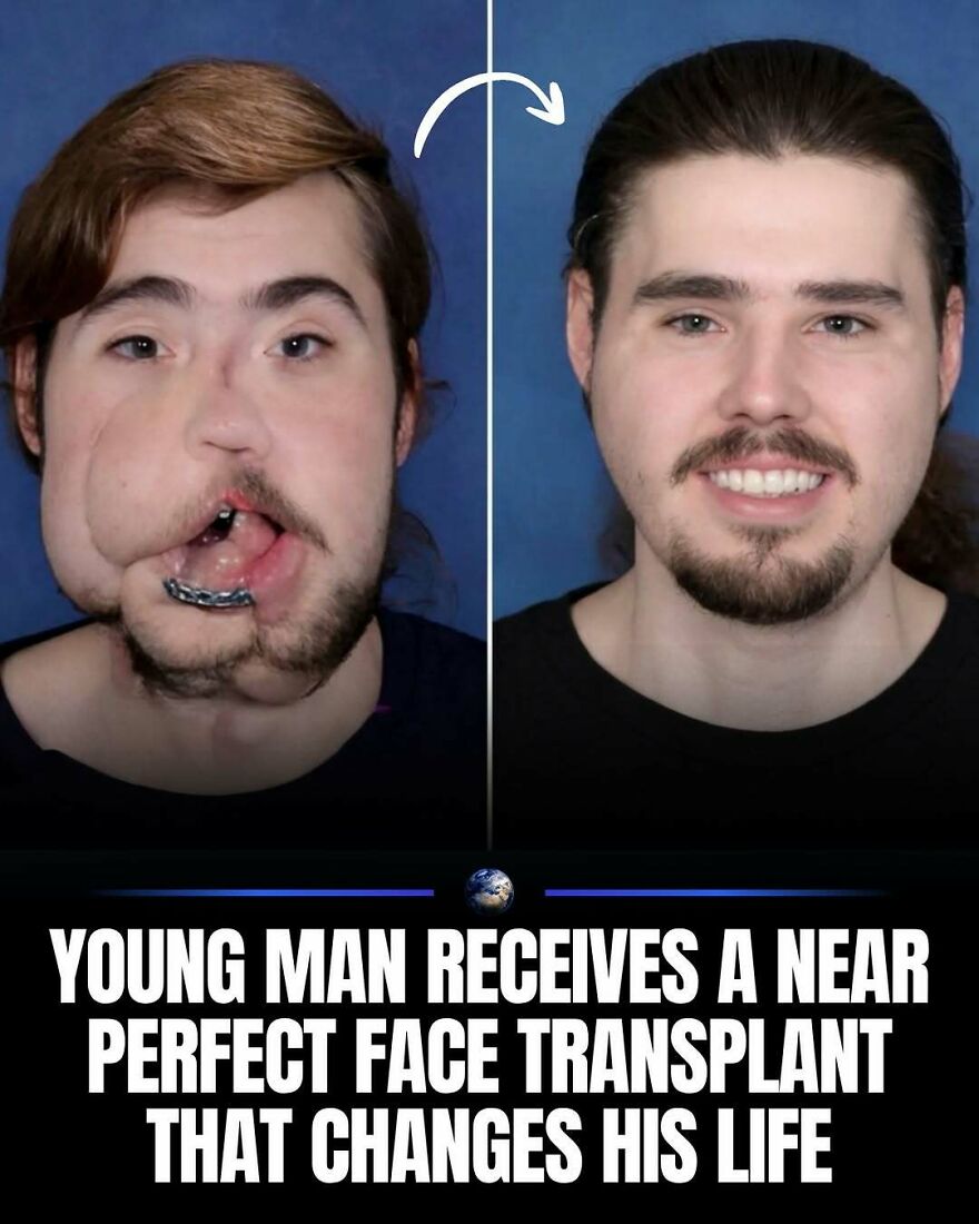 Before-and-after photos of a young man, showing his face before a transplant on the left and after a face transplant on the right, teaching something new about humanity.