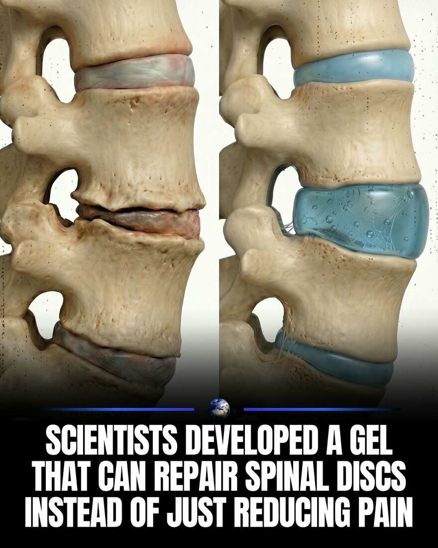 An illustration depicting spinal discs, showing a damaged disc on the left and a repaired disc with gel on the right, teaching something new about humanity.