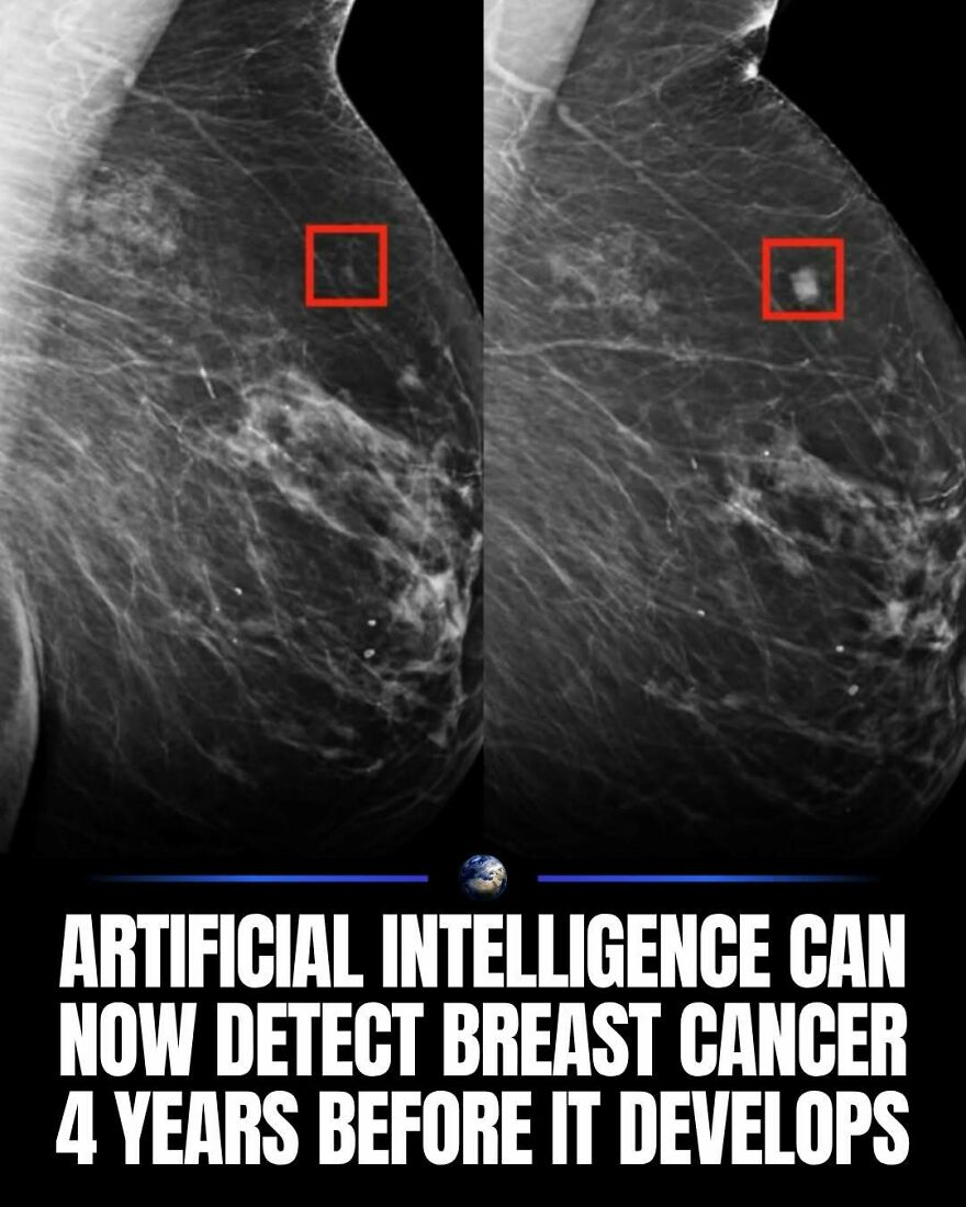 Breast cancer detection using Artificial Intelligence, showing its impact on humanity.