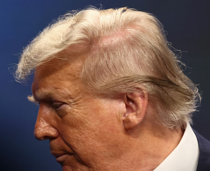 Close up of Trump's hair thinning showing hair-loss treatment details