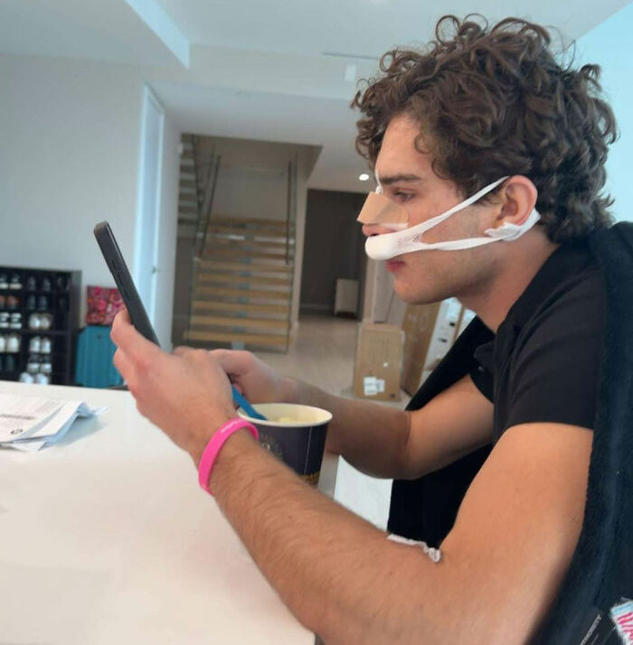 Young man with facial bandages using phone after Looksmaxxer Clavicular surgery
