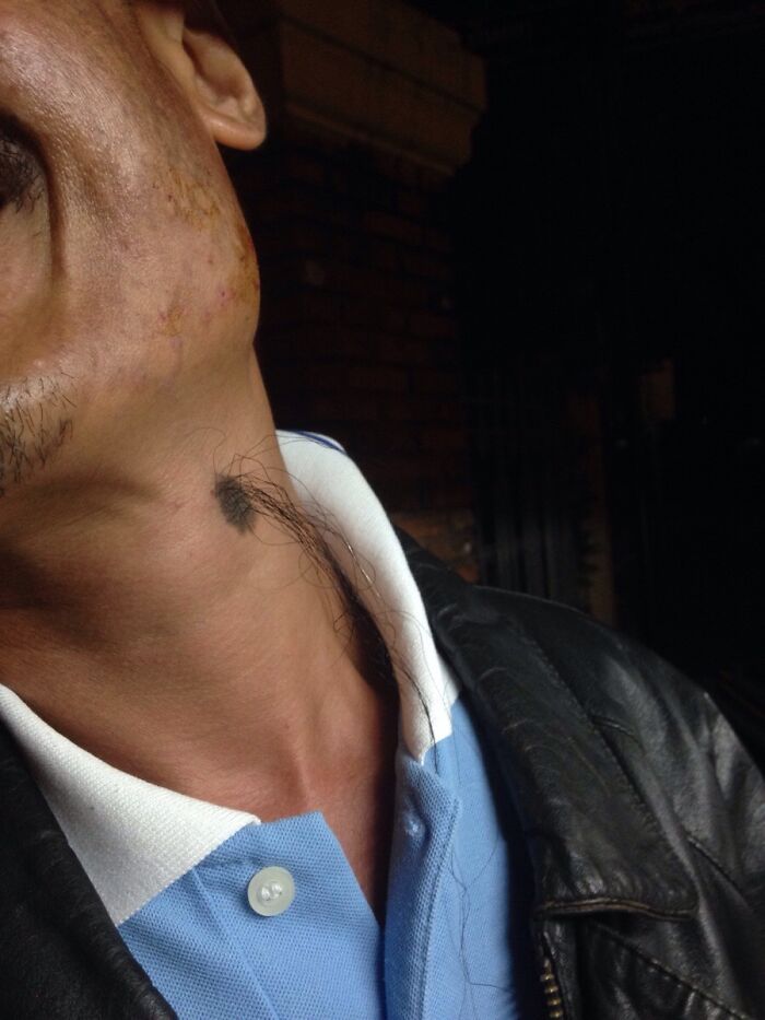 Unusual human body quirk showing hair growth from neck