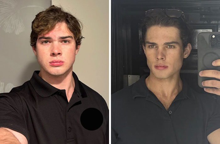 Before and after transformation photos of looksmaxxer Clavicular