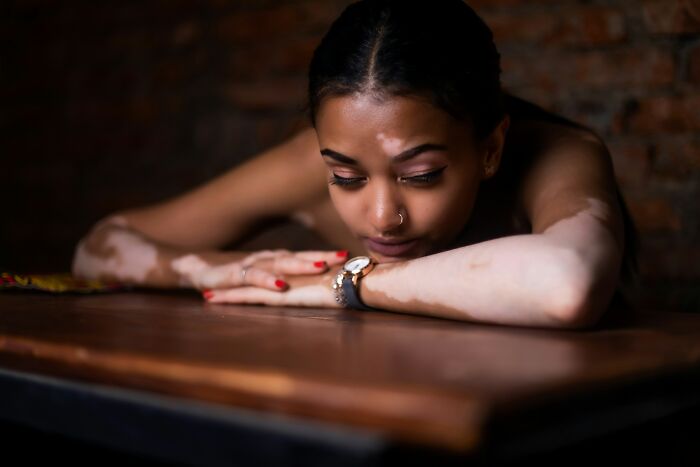 Woman with vitiligo resting on a wooden table looking reflective
