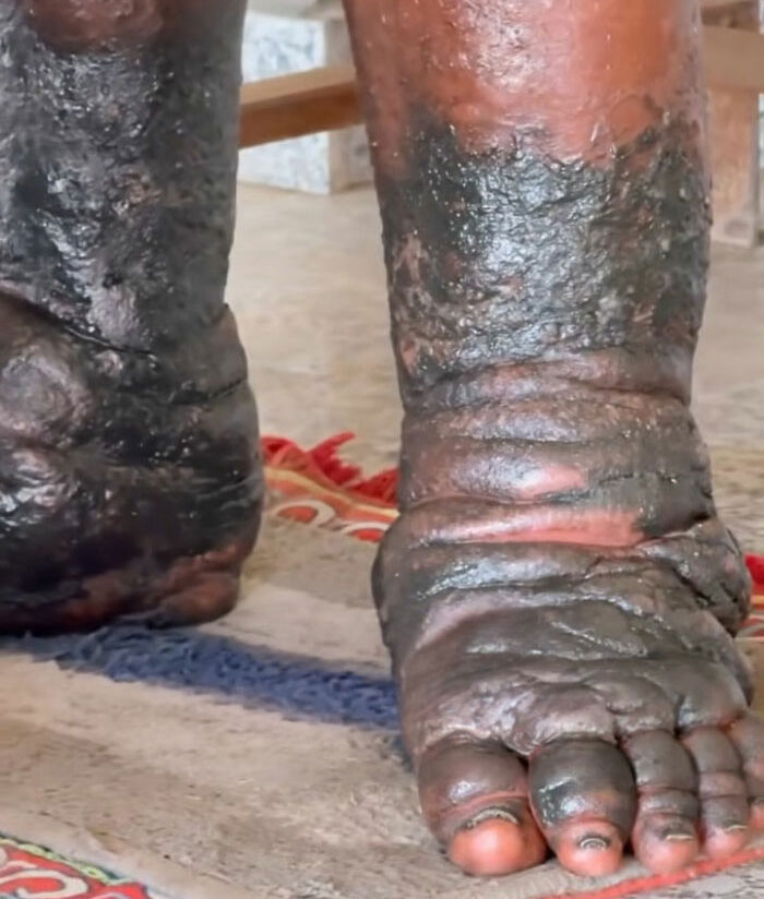 The discolored and swollen feet of a man standing for over 5 years, showing the physical toll of his extreme act of devotion. The discolored and swollen feet of a man standing for over 5 years, showing the physical toll of his extreme act of devotion.