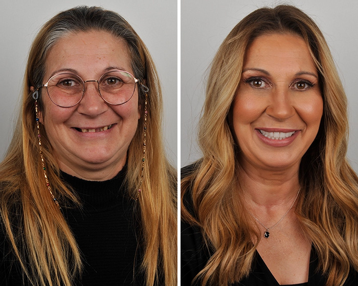 Smile makeover before and after collage with enhanced dental appearance