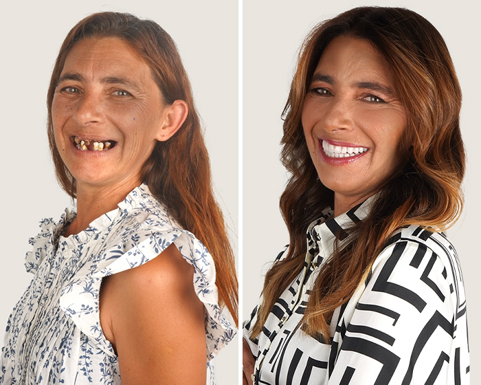 Before and after smile makeover collage showing dramatic dental transformation