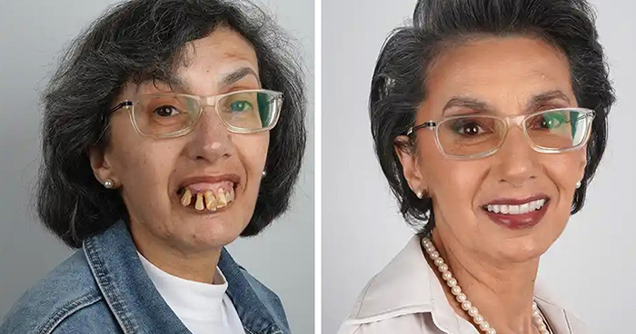 10 Jaw-Dropping Before-And-After Collages Of Women Who Underwent Extensive Smile Makeovers