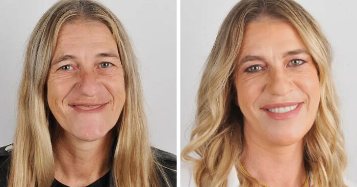 10 Jaw-Dropping Before-And-After Collages Of Women Who Underwent Extensive Smile Makeovers