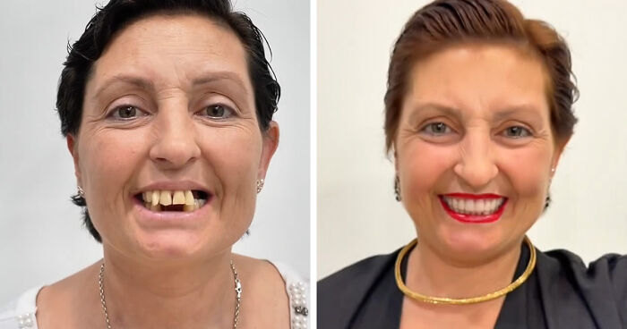 8 Jaw-Dropping Before-And-After Collages Of Women Who Underwent Extensive Smile Makeovers