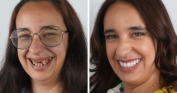 8 Jaw-Dropping Before-And-After Collages Of Women Who Underwent Extensive Smile Makeovers