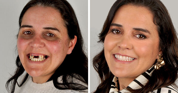 8 Jaw-Dropping Before-And-After Collages Of Women Who Underwent Extensive Smile Makeovers