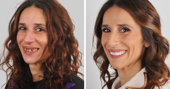 8 Jaw-Dropping Before-And-After Collages Of Women Who Underwent Extensive Smile Makeovers