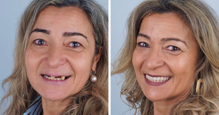 8 Jaw-Dropping Before-And-After Collages Of Women Who Underwent Extensive Smile Makeovers