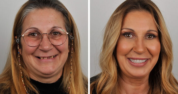 8 Jaw-Dropping Before-And-After Collages Of Women Who Underwent Extensive Smile Makeovers
