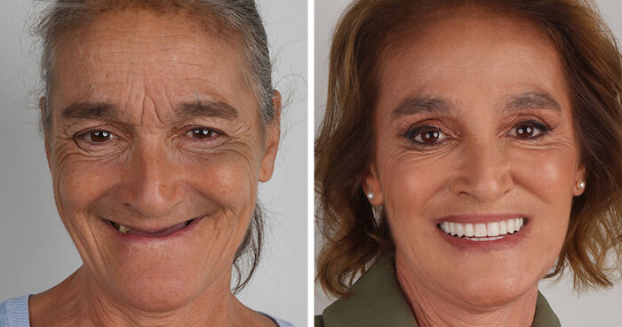 8 Jaw-Dropping Before-And-After Collages Of Women Who Underwent Extensive Smile Makeovers
