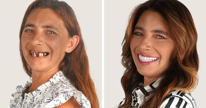 8 Jaw-Dropping Before-And-After Collages Of Women Who Underwent Extensive Smile Makeovers