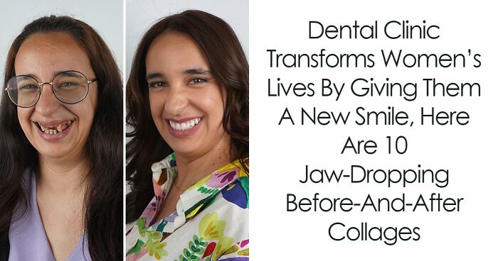8 Jaw-Dropping Before-And-After Collages Of Women Who Underwent Extensive Smile Makeovers