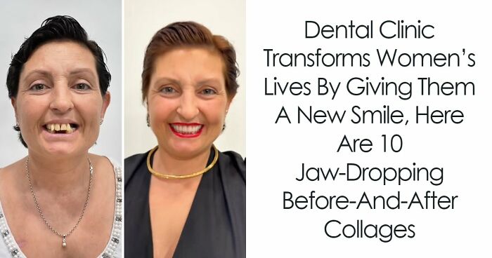 8 Jaw-Dropping Before-And-After Collages Of Women Who Underwent Extensive Smile Makeovers