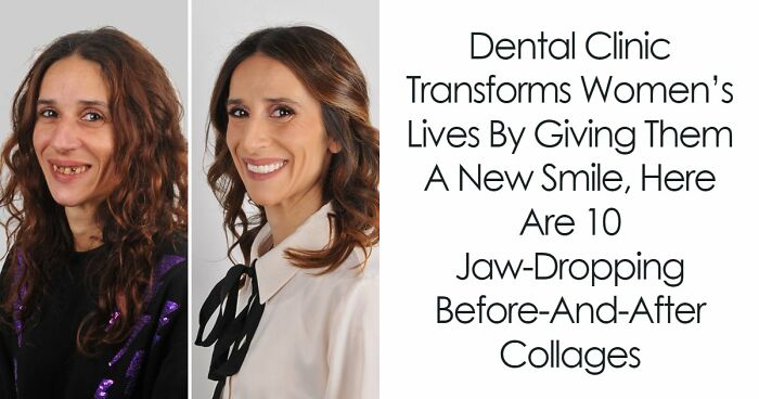 8 Jaw-Dropping Before-And-After Collages Of Women Who Underwent Extensive Smile Makeovers