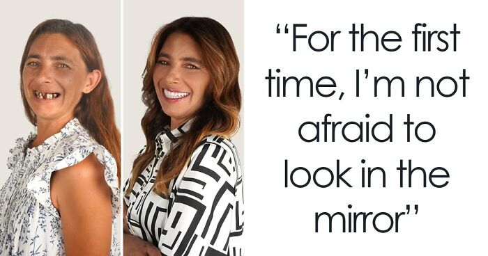 8 Jaw-Dropping Before-And-After Collages Of Women Who Underwent Extensive Smile Makeovers