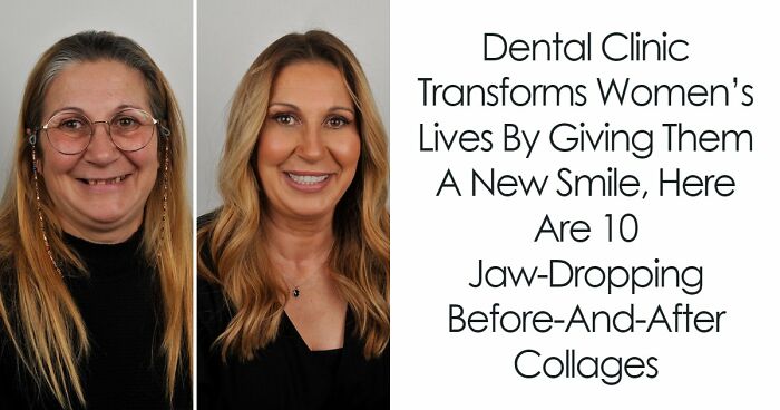 8 Jaw-Dropping Before-And-After Collages Of Women Who Underwent Extensive Smile Makeovers