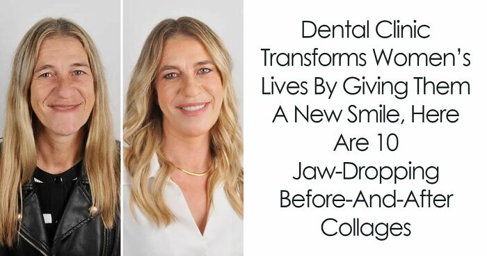 8 Jaw-Dropping Before-And-After Collages Of Women Who Underwent Extensive Smile Makeovers