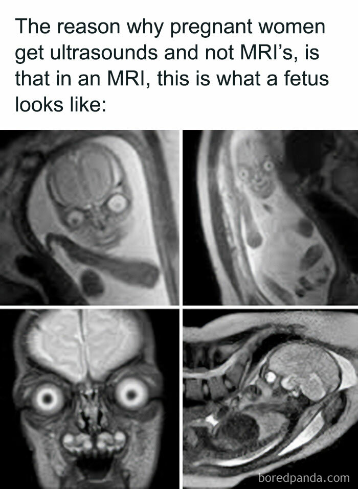 A blursed meme of a fetus in an MRI, showing a creepy image for a blursed laugh.
