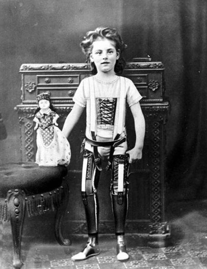 Historical photos: Young girl with leg braces and a doll in a vintage black and white photo.