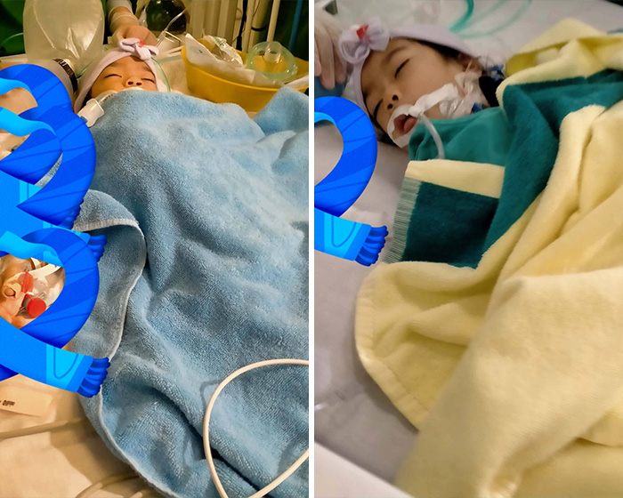 Two 2-year-old conjoined twins resting separately in hospital beds after successful separation surgery. Two 2-year-old conjoined twins resting separately in hospital beds after successful separation surgery.
