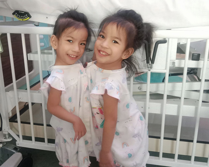 Happy 2-year-old conjoined twins in the hospital, showing their unique bond before separation surgery. Happy 2-year-old conjoined twins in the hospital, showing their unique bond before separation surgery.