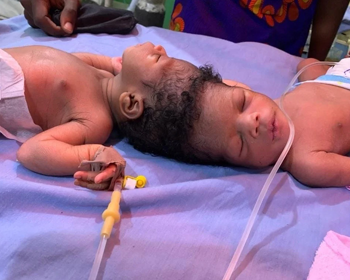 Newborn conjoined twins before their grueling separation surgery, lying together on a medical table. Newborn conjoined twins before their grueling separation surgery, lying together on a medical table.