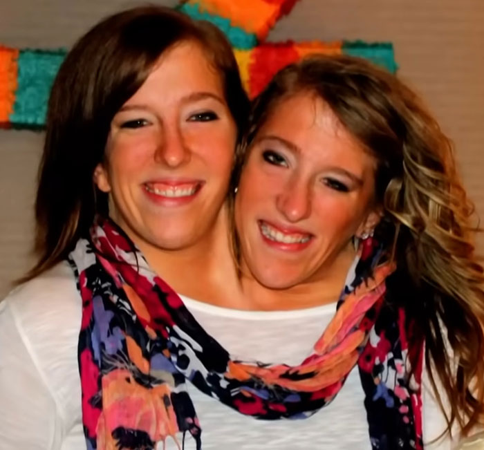 Happy 2-year-old conjoined twins successfully separated post-surgery, smiling and wearing a colorful scarf. Happy 2-year-old conjoined twins successfully separated post-surgery, smiling and wearing a colorful scarf.