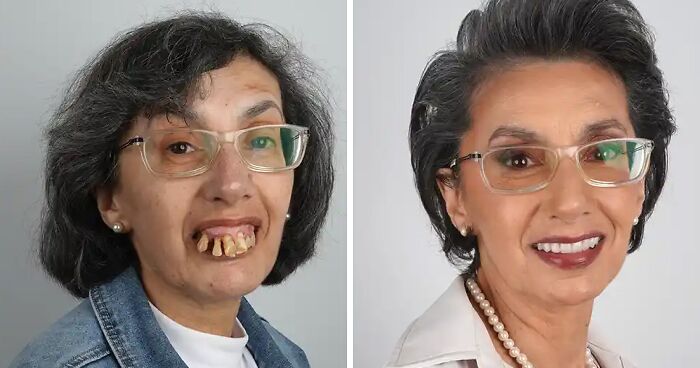 8 Jaw-Dropping Before-And-After Collages Of Women Who Underwent Extensive Smile Makeovers