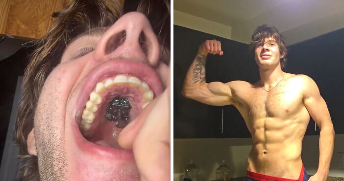 Doctor Warns Of The Risks After “Looksmaxxer” Films Himself Using A Maxilla Expander