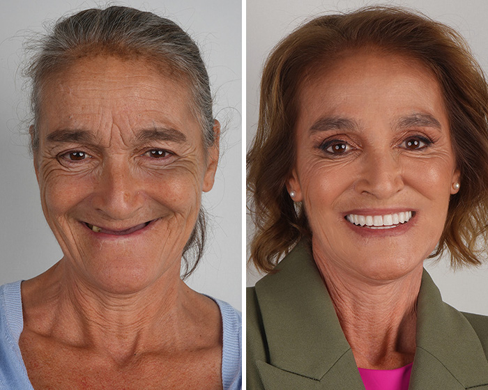 Jaw-dropping smile makeover before and after of woman with bright white teeth