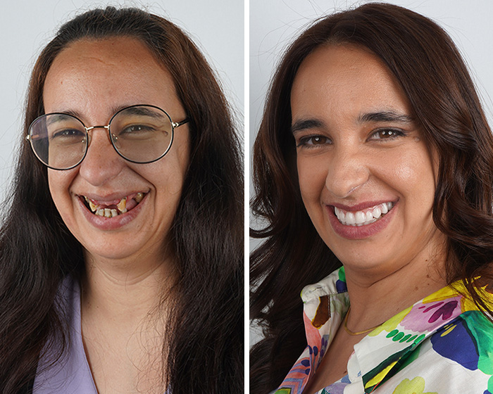 Before and after smile makeover featuring woman with enhanced dental aesthetics