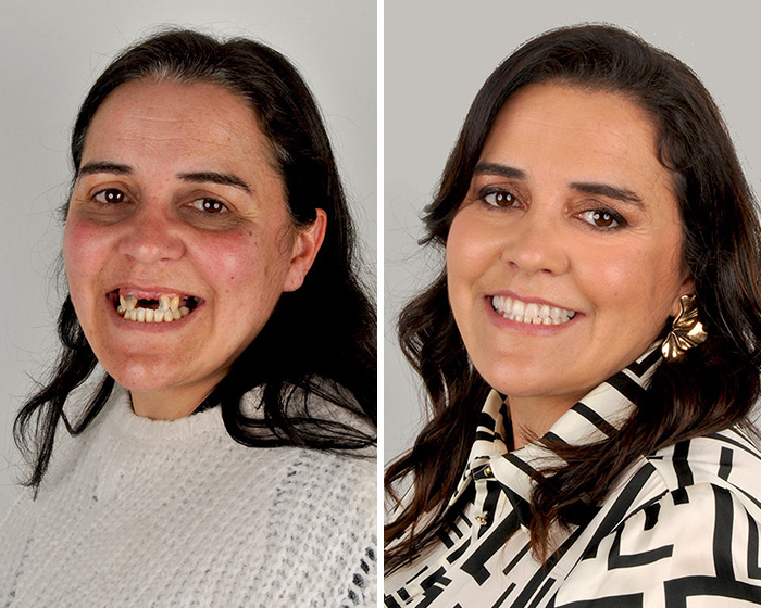 Extensive smile makeover before after showing dental restoration progress