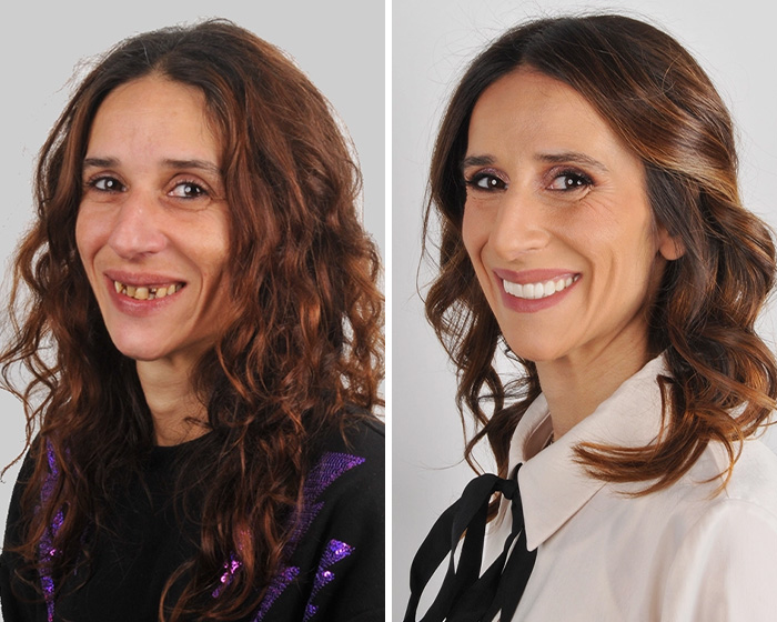 Smile makeover before and after of woman with improved teeth and smile