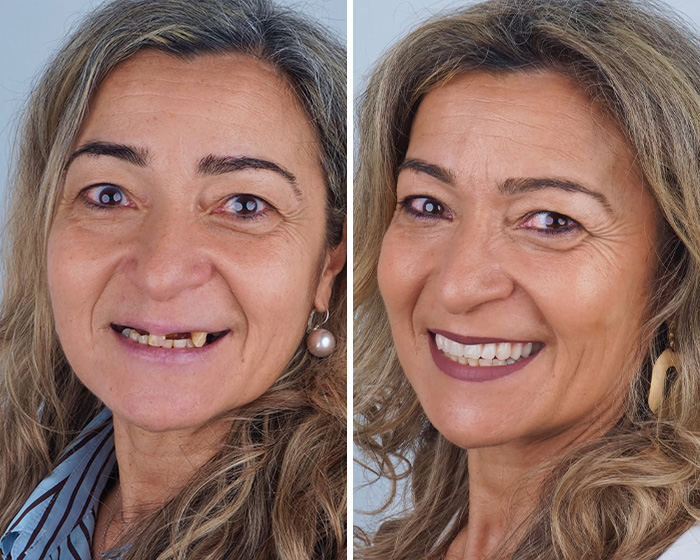 Close-up before and after smile makeover showing improved dental health