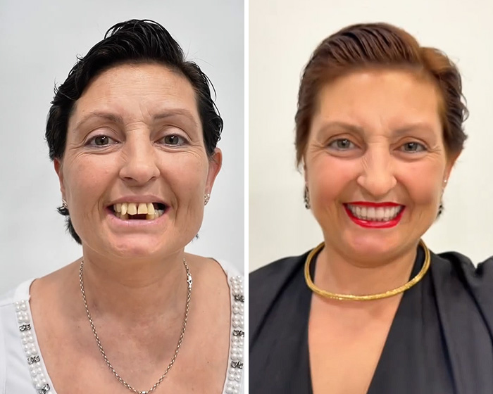 Before and after collage of woman smiling after extensive smile makeover