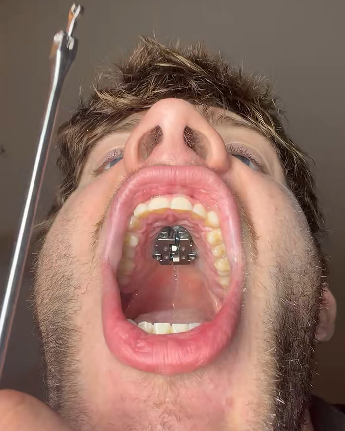 Close-up of open mouth showing a maxilla expander dental device Close-up of open mouth showing a maxilla expander dental device