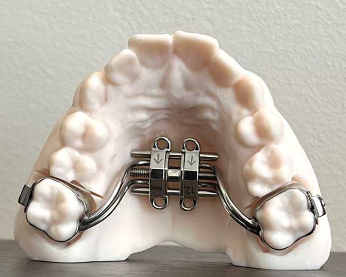 Close-up of maxilla expander device on dental mold for orthodontic treatment Close-up of maxilla expander device on dental mold for orthodontic treatment